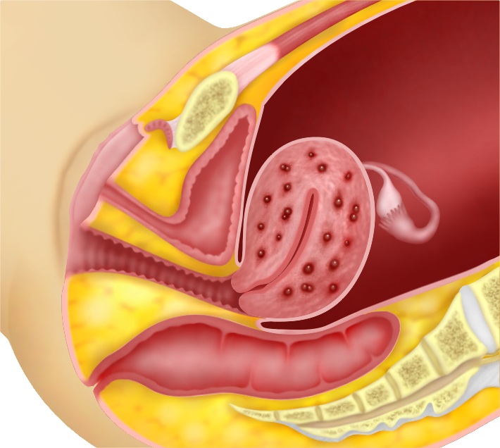 https://melakafertility.com/wp-content/uploads/2020/09/Fig-4.1-adenomyosis-involving-the-whole-uterus.jpg
