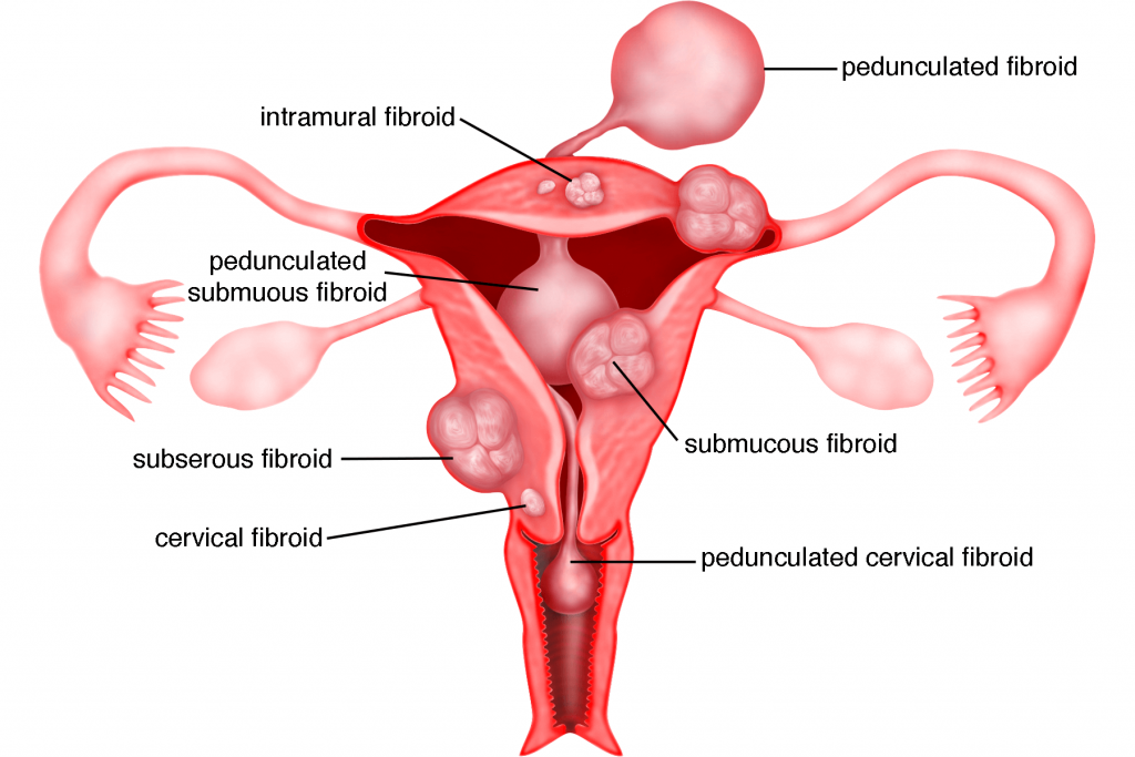 Bab 2 – Fibroid Rahim – Melaka Fertility – Selva's Fertility, Obstetrics  and Gynaecology Clinic