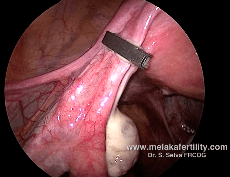 laparoscopic tubal ligation