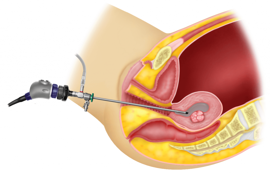 Chapter 36 – Overview of Hysteroscopy – Melaka Fertility