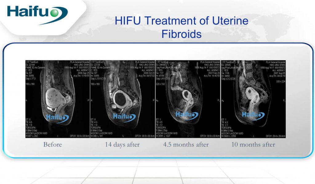 Figure 2: HIFU Treatment for Fibroid